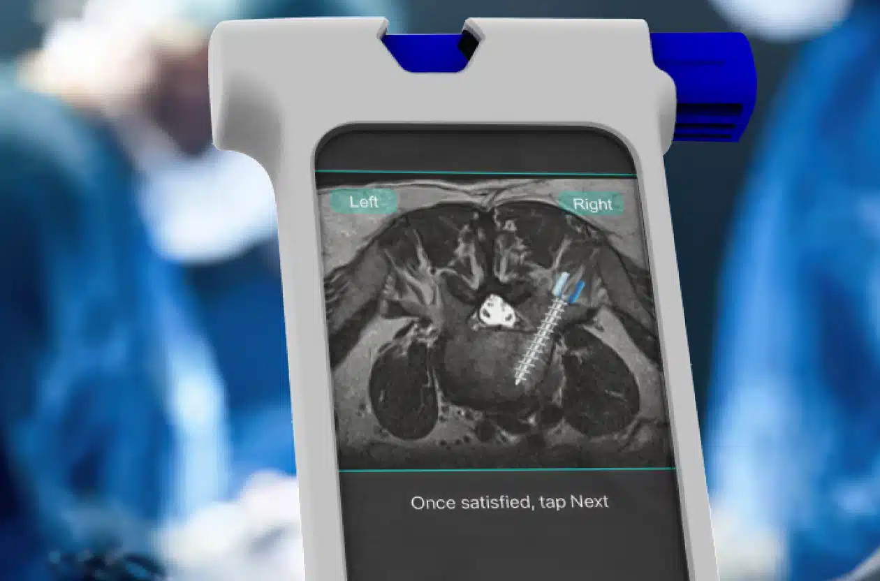 Bolt Navigation in use during spine surgery